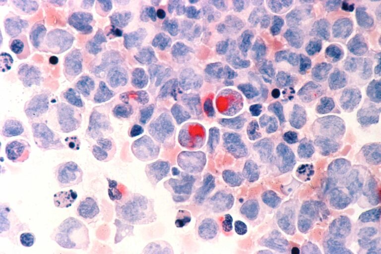 Leukemia aml1 768x512